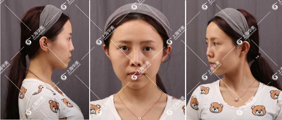 上海华美自体脂肪填充技术好吗？面部自体脂肪填充哪个医生好？专家案例大PK~