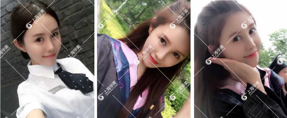 上海华美自体脂肪填充技术好吗？面部自体脂肪填充哪个医生好？专家案例大PK~