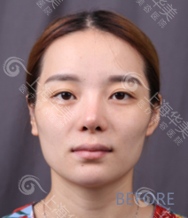 上海华美自体脂肪填充技术好吗？面部自体脂肪填充哪个医生好？专家案例大PK~