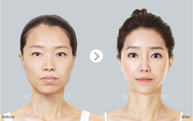 上海华美许再荣双眼皮怎么样？技术好吗？ 怎么预约许再荣医生？