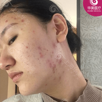 上海华美激光祛斑怎么样_华美祛斑价格表2019_激光祛斑专家_真人案例效果