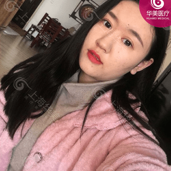 上海华美激光祛斑怎么样_华美祛斑价格表2019_激光祛斑专家_真人案例效果