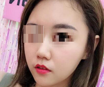 颧弓内推，下颌角磨骨都出自上海华美李志海之手，术后的效果让我惊喜又激动