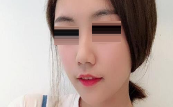 颧弓内推，下颌角磨骨都出自上海华美李志海之手，术后的效果让我惊喜又激动