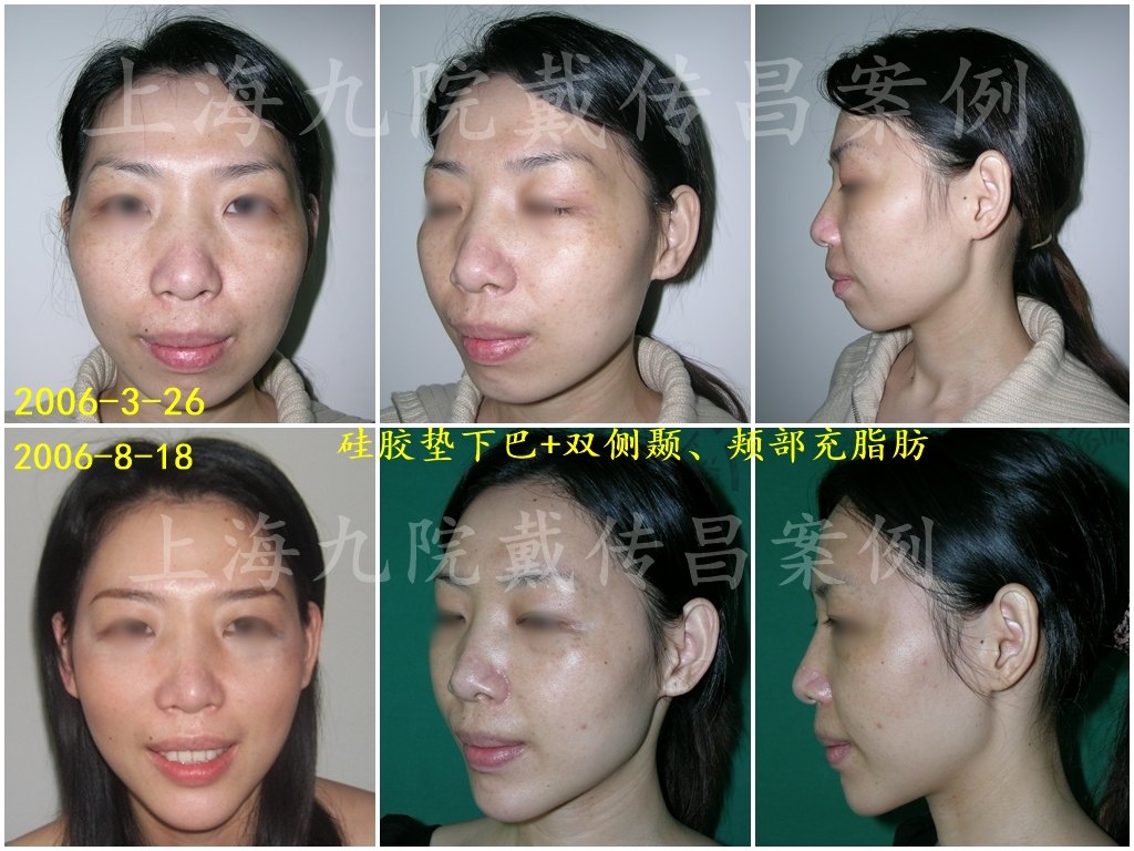 上海九院戴传昌全脸软雕技术效果好不好?什么是全脸软雕?