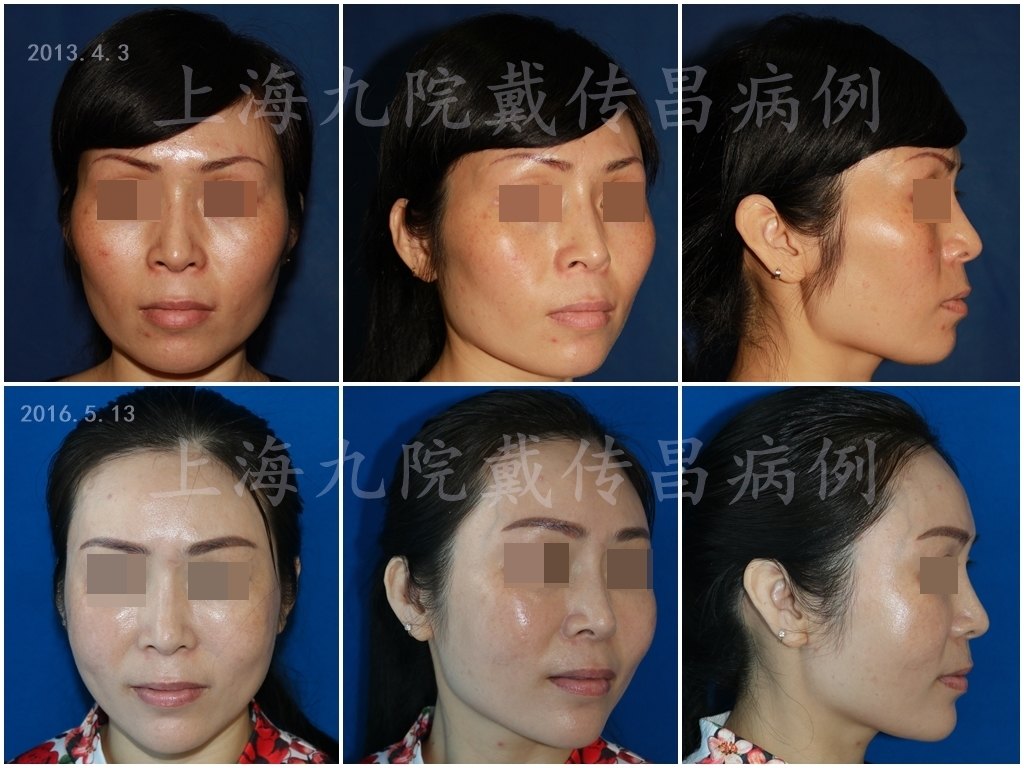上海九院戴传昌全脸软雕技术效果好不好?什么是全脸软雕?