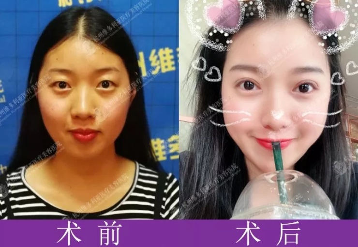 杭州维多利亚马康医生双眼皮技术好不好?口碑怎么样?案例效果?