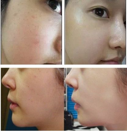 杭州维多利亚马腾打玻尿酸水光*怎么样?价格多少钱?