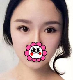 杭州瑞丽整形做双眼皮、全脸填充怎么样?徐少俊自体脂肪面部填充技术好吗?