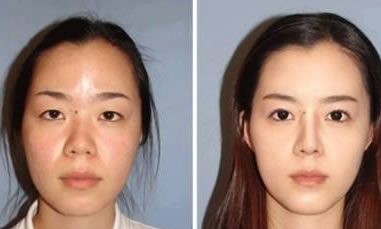 杭州瑞丽整形何涛做鼻子怎么样?技术效果好不好?