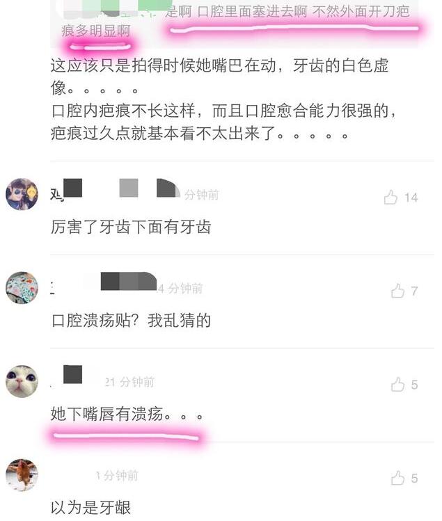 沈梦辰口中惊现“垫下巴白色假体”，整形传闻不攻自破？