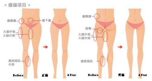 杭州大腿吸脂哪家医院好?杭州大腿吸脂多少钱?