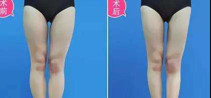 杭州大腿吸脂哪家医院好?杭州大腿吸脂多少钱?