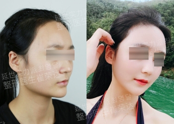 上海首尔丽格整脸型怎么样?崔荣达做脸型怎么样?想改下颌骨
