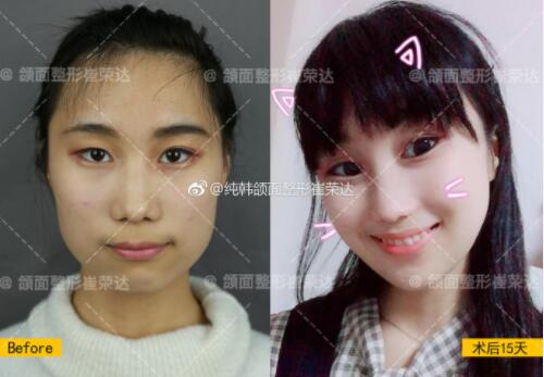 上海首尔丽格崔荣达告诉你颧骨颧弓和下颌角手术后注意事项
