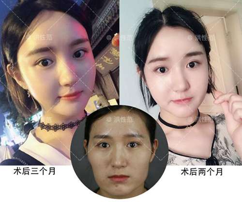 上海首尔丽格洪性范磨骨怎么样?有没有案例效果图呢?