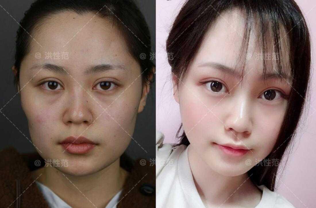 上海首尔丽格洪性范磨骨怎么样?有没有案例效果图呢?