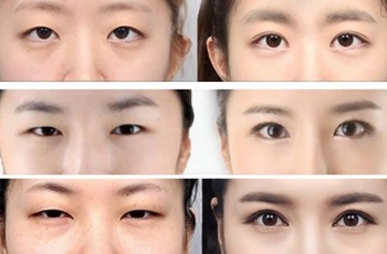 杭州美莱翟爽双眼皮技术怎么样?想找翟爽医生割双眼皮