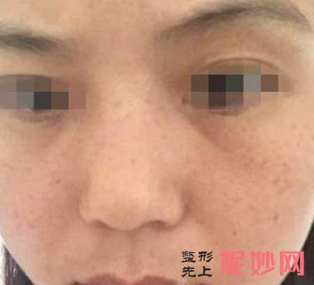 广州军区总医院激光整形中心怎么样?医生推荐,附带案例详情
