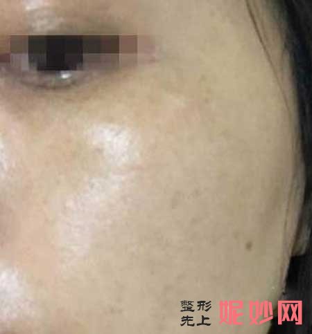 广州军区总医院激光整形中心怎么样?医生推荐,附带案例详情