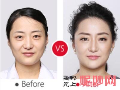 找重庆鹏爱医美的王琪斌医生做线雕，年轻了十岁