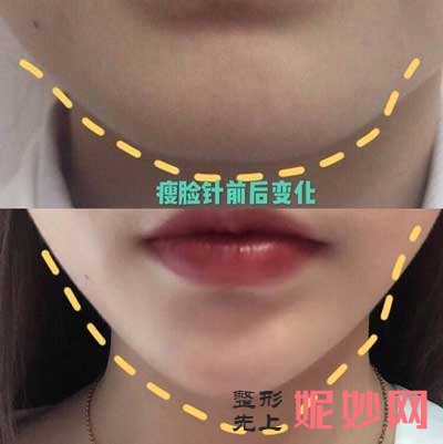 找重庆鹏爱医美的王琪斌医生做线雕，年轻了十岁