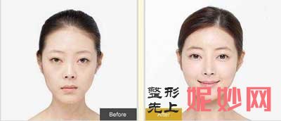 重庆美莱整形美容郑楠医生做双眼皮怎么样?案例分享