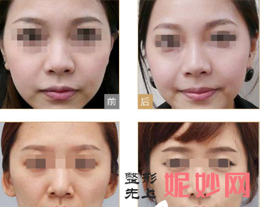 重庆整形隆鼻怎么样?美莱韦小勇医生隆鼻真实案例分享