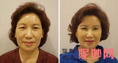 重庆时光整形美容肖庆彦整形技术好吗?案例口碑