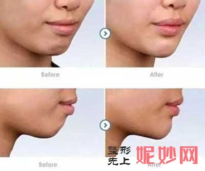 重庆美莱整形刘思思注射玻尿酸怎么样?口碑好吗?案例
