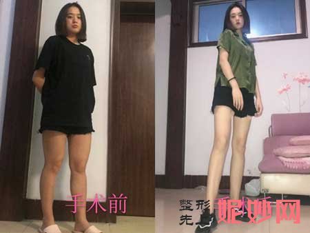 郑州辰星医疗美容医院于鑫吸脂技术怎么样?大腿吸脂案例分享,门诊时间,价格
