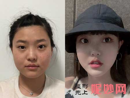 郑州东方整形美容医院吴振整形技术怎么样?擅长项目,隆鼻案例分享