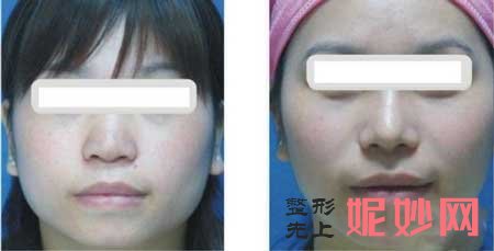 郑州辰星医疗美容医院王保健做鼻部失败修复好吗?个人简历,案例分享