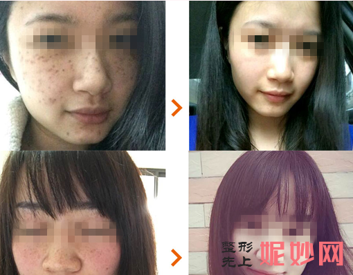 重庆美仑美奂整形美容肖倩祛斑技术好吗?案例展示口碑