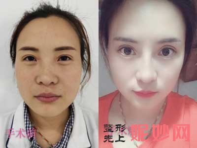 郑州东方整形美容医院贺洁眼整形技术好不好?案例,价格表