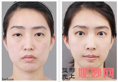 深圳瑞芙臣医疗美容门诊部李斌医生双眼皮整形技术好吗?效果展示口碑