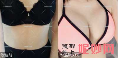 郑州芳艺医疗美容医院乔长顺做自体脂肪隆胸技术好不好?真人案例,价格表