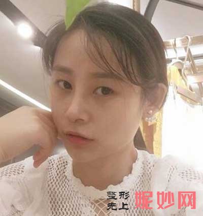 西京医院整形科崔江波医生怎么样?好不好?附带双眼皮案例分享