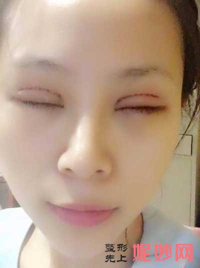 西京医院整形科崔江波医生怎么样?好不好?附带双眼皮案例分享