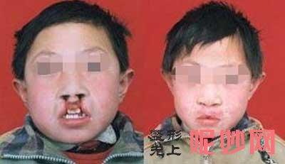 西京医院整形外科张曦医生做唇腭裂修复手术案例