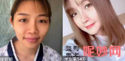 西京医院整形外科张曦医生做鼻综合手术案例