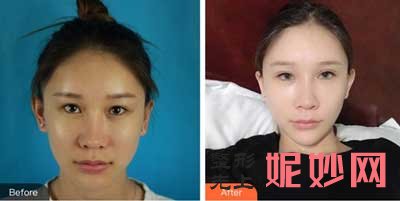 西京医院整形美容科做双眼皮效果怎么样?真人案例_价格表