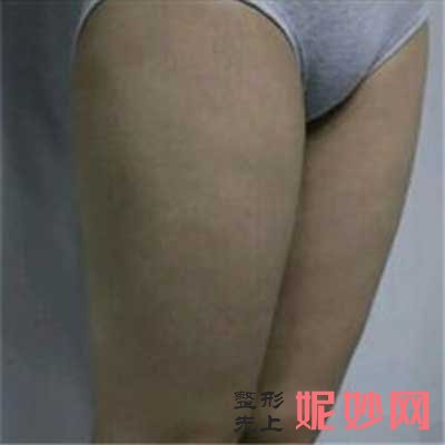 西安西京医院易成刚大腿吸脂技术好不好?吸脂后会出现明显的反弹、凹凸不平的现象吗?