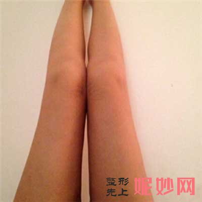 西安西京医院易成刚大腿吸脂技术好不好?吸脂后会出现明显的反弹、凹凸不平的现象吗?