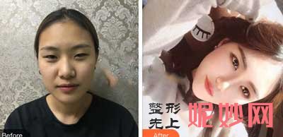 中日友好医院整形科高占巍技术怎么样?项目,案例,费用,出诊时间