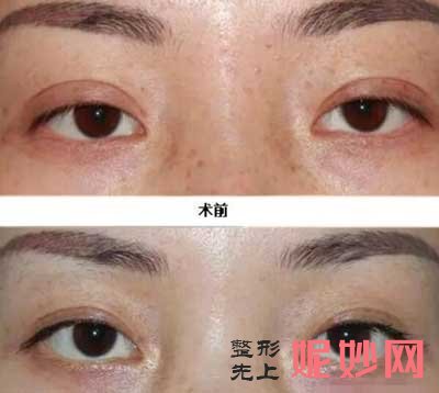 中日友好医院整形科高占巍怎么样?双眼皮修复案例+技术盘点