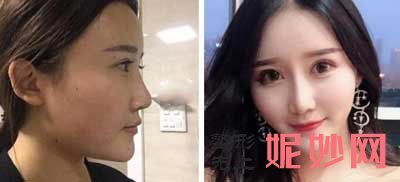 江苏省中医院整形外科黄金龙隆鼻怎么样?案例分享,价格,出诊时间表