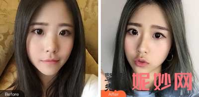 上海九院苏薇洁医生做双眼皮怎么样?自然吗?双眼皮案例?价格如何?