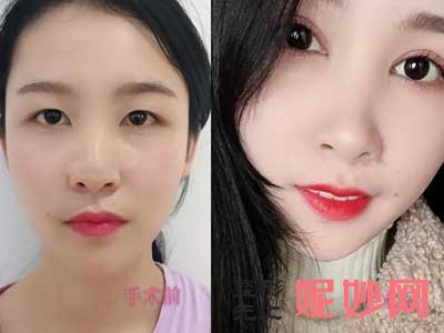 上海九院双眼皮谁做的自然?找哪个医生?双眼皮案例分享?价格?