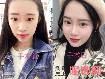 上海九院双眼皮谁做的自然?找哪个医生?双眼皮案例分享?价格?
